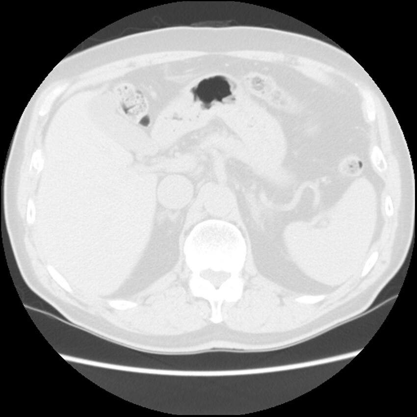 Asbestos-related pleural plaques (Radiopaedia 39069-41255 Axial lung window 72).jpg