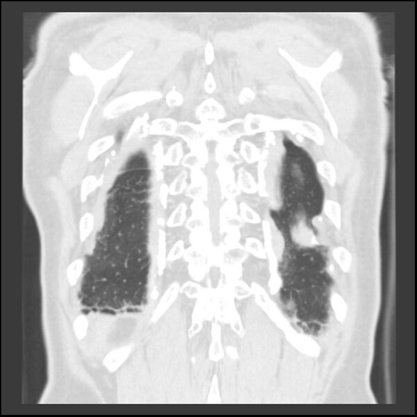 File:Asbestos-related pleural plaques (Radiopaedia 39069-41255 Coronal lung window 10).jpg