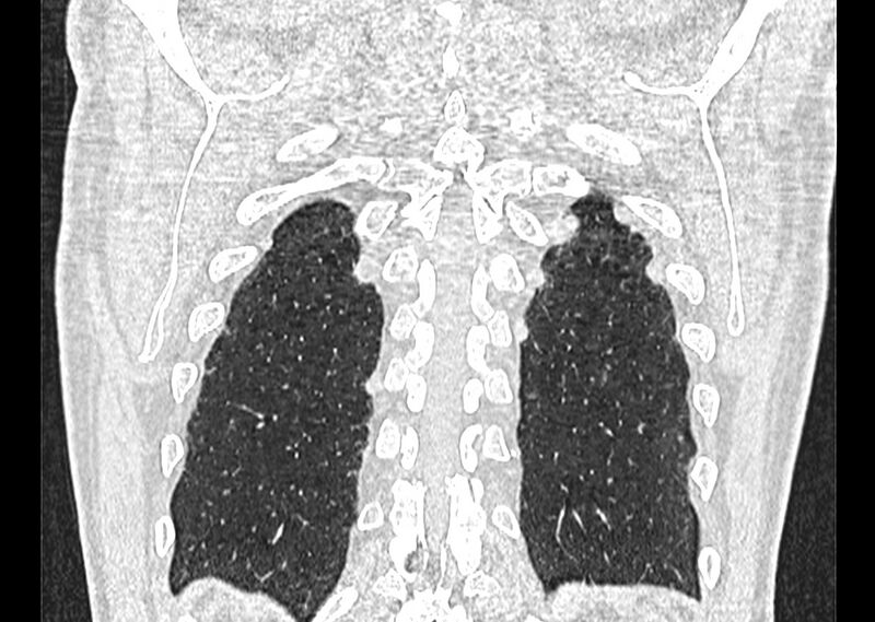 File:Asbestos pleural placques (Radiopaedia 57905-64872 Coronal lung window 254).jpg