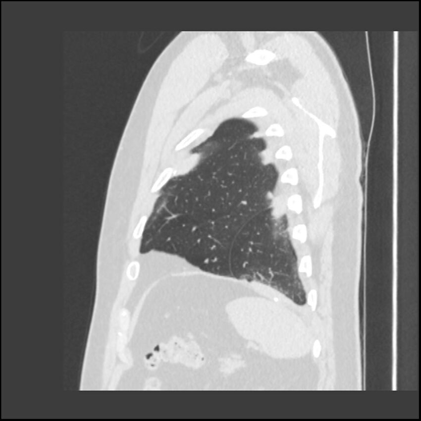 Asbestosis (Radiopaedia 45002-48961 Sagittal lung window 18).jpg