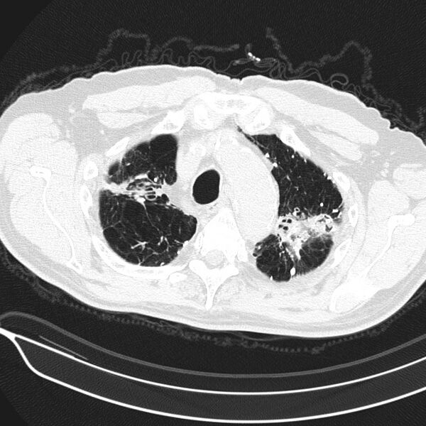 File:Aspergilloma (Radiopaedia 24521-24804 Axial lung window 3).jpg