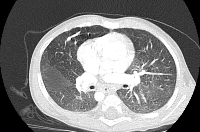 File:Asplenia syndrome (Radiopaedia 73083-83792 Axial lung window 32).jpg