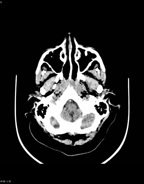 File:Astroblastoma (Radiopaedia 39792-42216 Axial non-contrast 5).jpg
