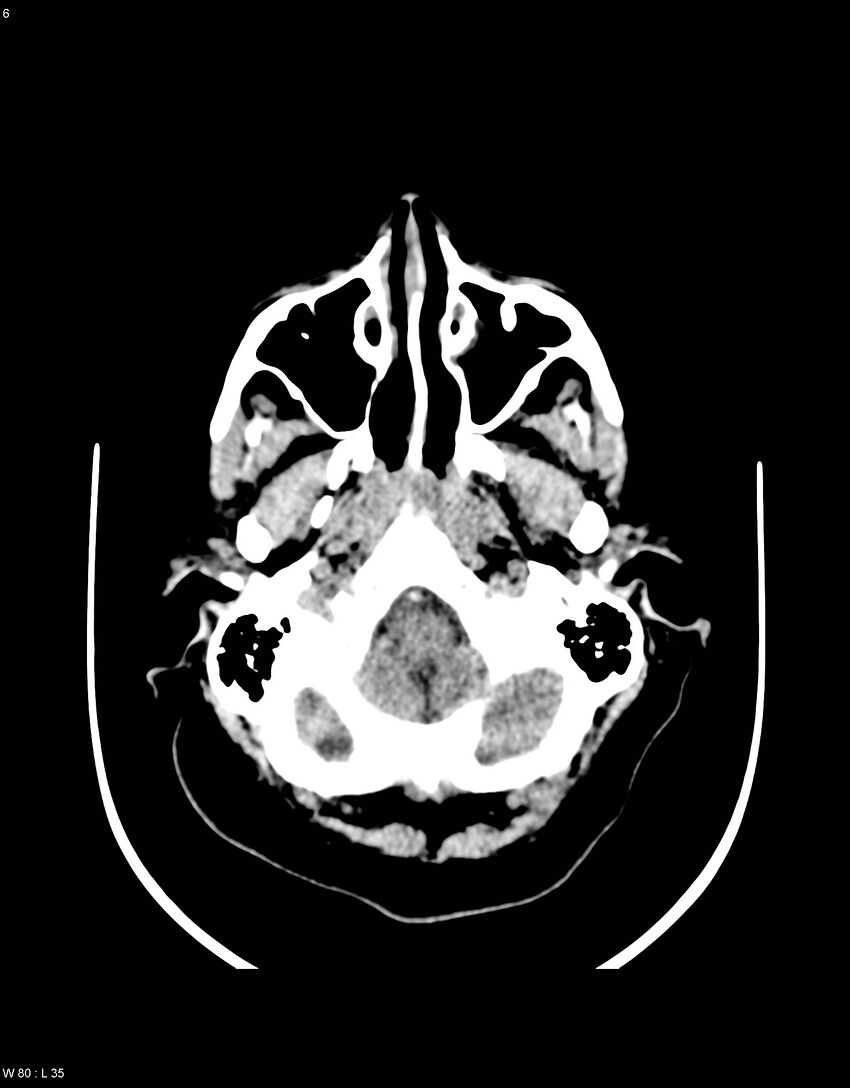 Astroblastoma (Radiopaedia 39792-42216 Axial non-contrast 5).jpg