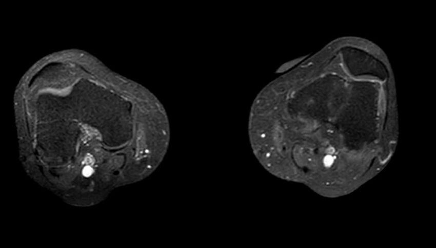 Atypical lipomatous tumor - thigh (Radiopaedia 68975-78734 Axial T1 C+ fat sat 11).jpg