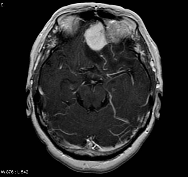 File:Atypical meningioma (WHO grade II) (Radiopaedia 5273-7016 Axial T1 C+ 1).jpg