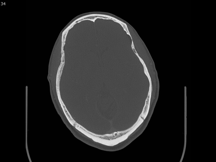 Atypical meningioma - intraosseous (Radiopaedia 64915-73867 Axial C+ bone window 34).jpg