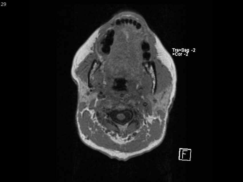 Atypical meningioma - intraosseous (Radiopaedia 64915-74572 Axial T1 29).jpg