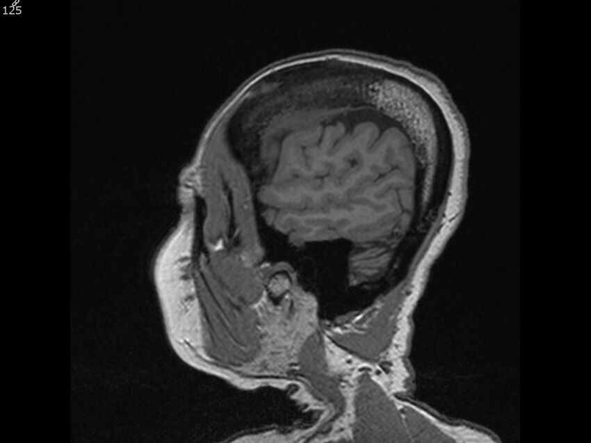 Atypical meningioma - intraosseous (Radiopaedia 64915-74572 Sagittal T1 125).jpg