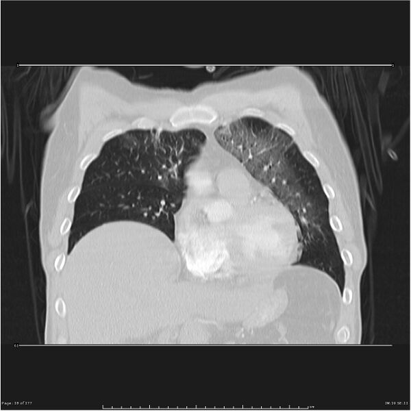File:Atypical pneumonia - Q fever (Radiopaedia 21993-21989 C 11).jpg