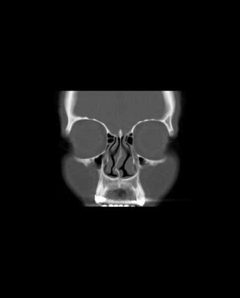 File:Automastoidectomy with labyrinthine fistula (Radiopaedia 84143-99411 Coronal non-contrast 15).jpg