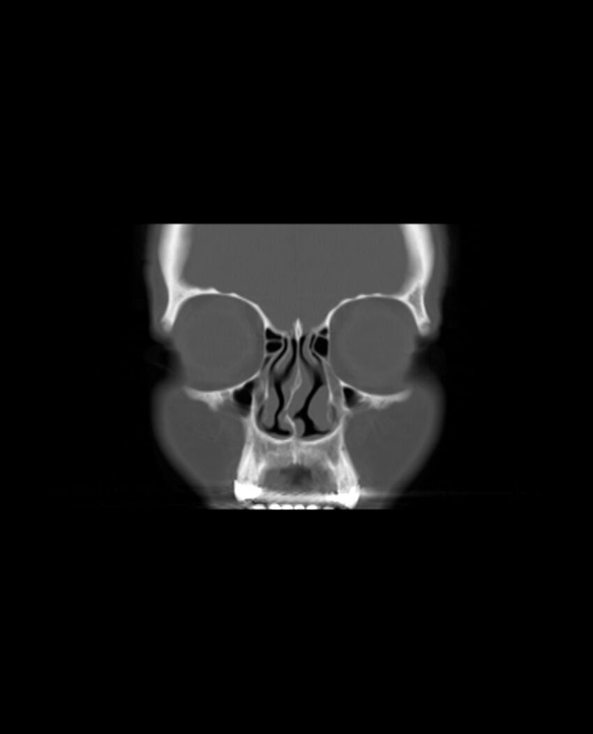 Automastoidectomy with labyrinthine fistula (Radiopaedia 84143-99411 Coronal non-contrast 15).jpg