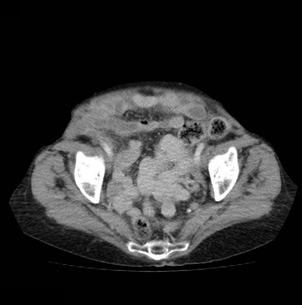 File:Autosomal dominant polycystic kidney disease (Radiopaedia 16777-16490 A 49).jpg