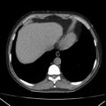 Autosomal dominant polycystic kidney disease (Radiopaedia 36539-38101 Axial non-contrast 9).jpg