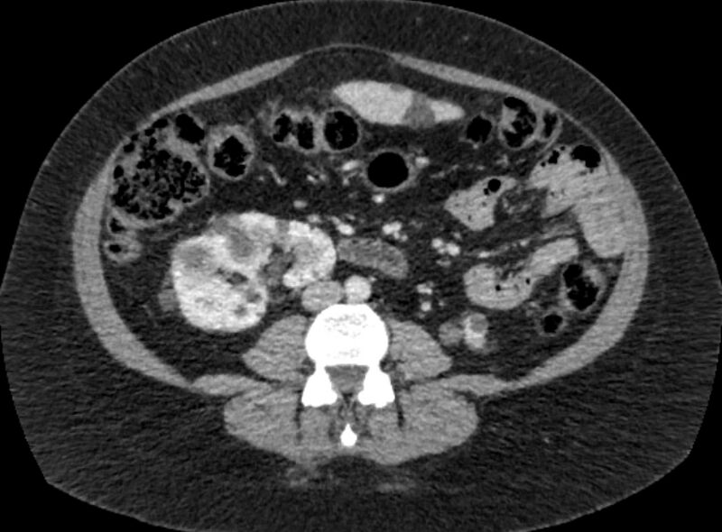 File:Autosomal dominant polycystic kidney disease (Radiopaedia 57124-64017 A 65).jpg
