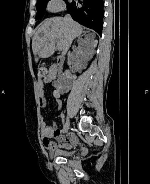 File:Autosomal dominant polycystic kidney disease (Radiopaedia 87830-104287 C 33).jpg