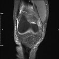 Avulsion fracture of the fibular head (Radiopaedia 74804-85808 Coronal PD fat sat 11).jpg