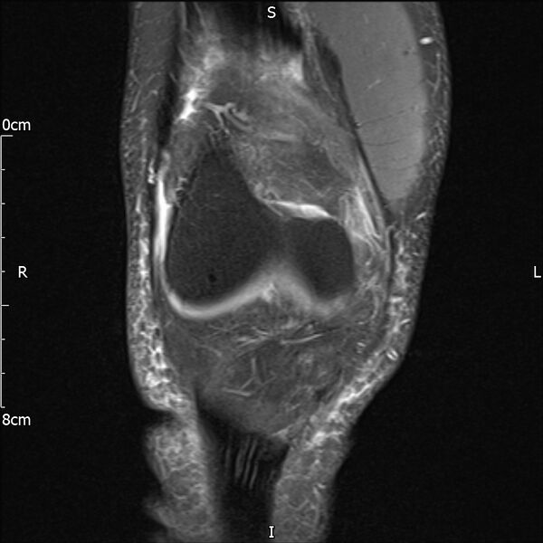 File:Avulsion fracture of the fibular head (Radiopaedia 74804-85808 Coronal PD fat sat 11).jpg