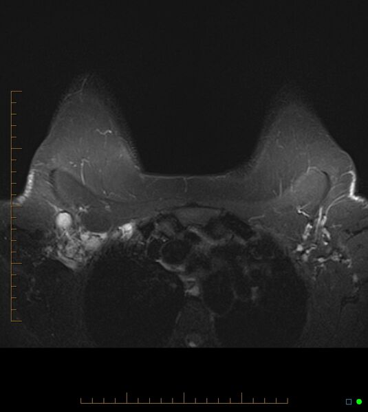 File:Axillary lymphadenopathy on breast MRI- yellow fever vaccination induced (Radiopaedia 19454-19483 Axial T2 fat sat 4).jpg