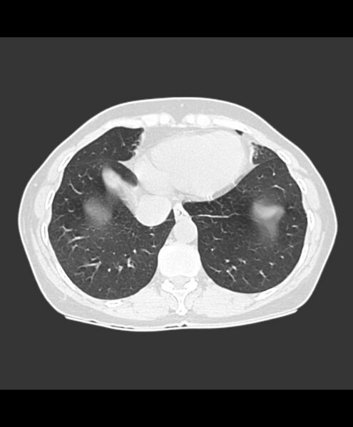 File:Azygos fissure and azygos lobe (Radiopaedia 41841-44832 Axial lung window 1).jpg