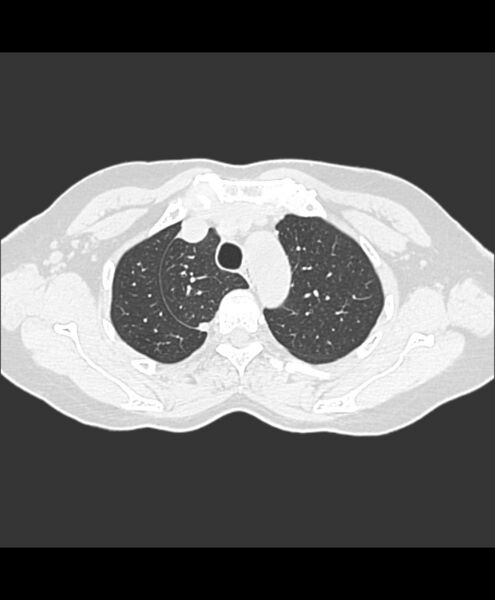 File:Azygos fissure and azygos lobe (Radiopaedia 41841-44832 Axial lung window 27).jpg