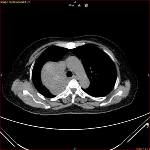 File:Azygos vein aneurysm (Radiopaedia 77824-90130 A 21).jpg
