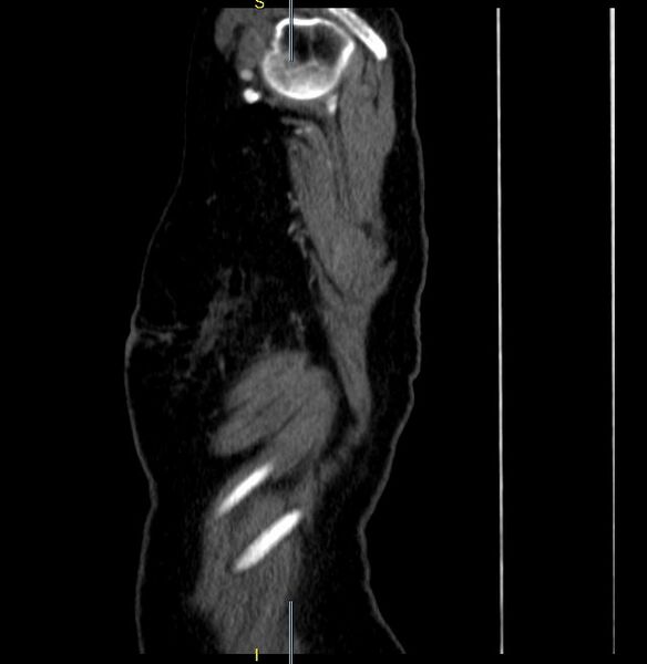 File:Azygos vein aneurysm (Radiopaedia 77824-90130 D 34).JPG