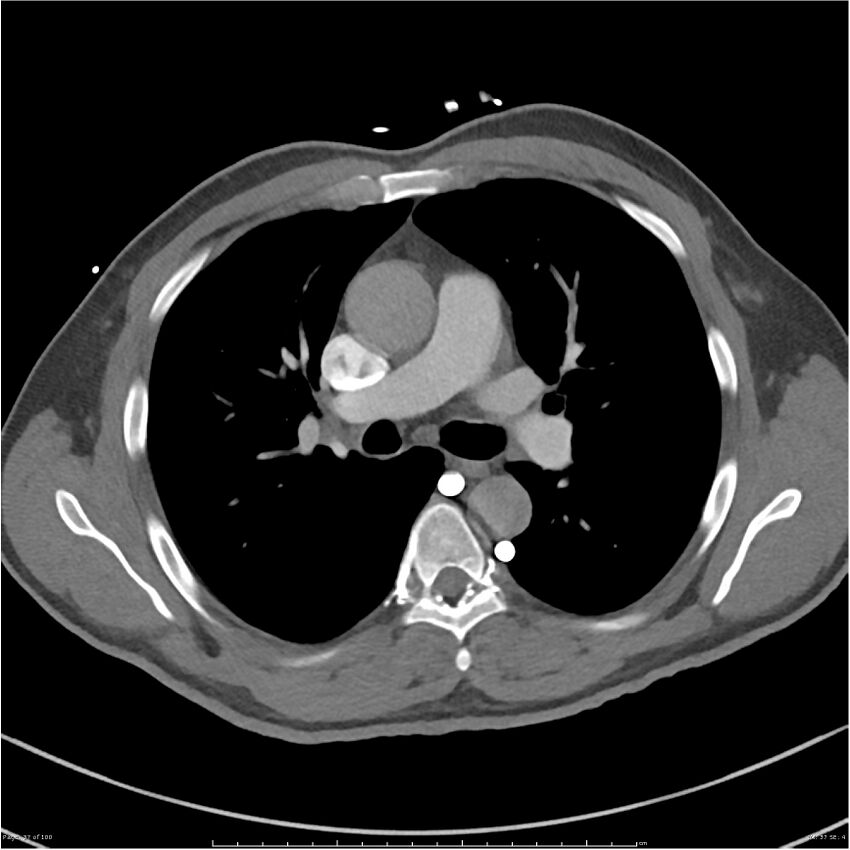 Azygos venous system anatomy (CT pulmonary angiography) (Radiopaedia 25928-26077 Axial C+ CTPA 37).jpg