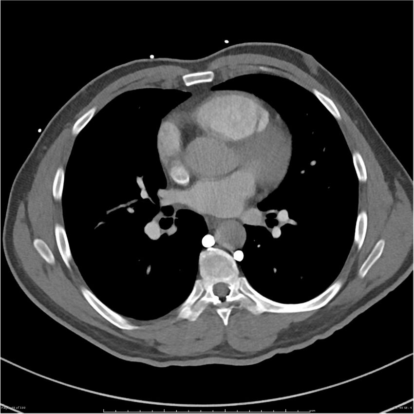 Azygos venous system anatomy (CT pulmonary angiography) (Radiopaedia 25928-26077 Axial C+ CTPA 49).jpg