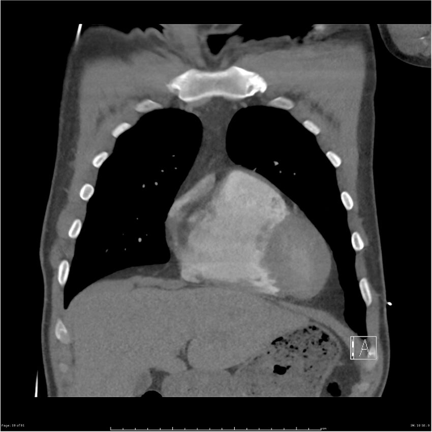 Azygos venous system anatomy (CT pulmonary angiography) (Radiopaedia 25928-26077 Coronal C+ CTPA 18).jpg