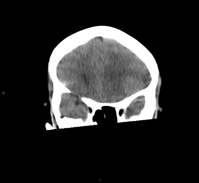 File:Basal ganglia hemorrhage (Radiopaedia 58759-65981 Coronal non-contrast 49).jpg