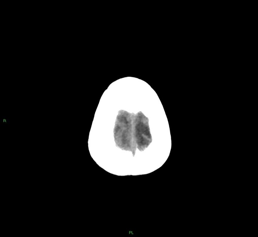 Basal ganglia hemorrhage (Radiopaedia 58766-65988 Axial non-contrast 9).jpg