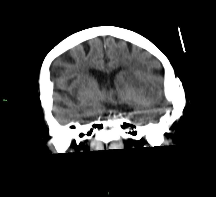 Basal ganglia hemorrhage (Radiopaedia 58790-66024 Coronal non-contrast 35).jpg