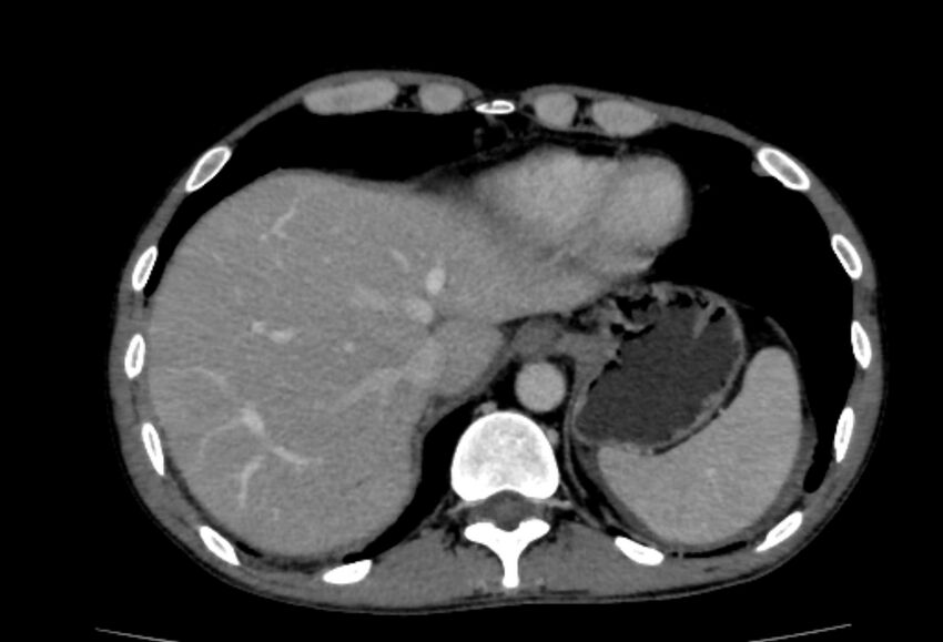 Behçet's disease- abdominal vasculitis (Radiopaedia 55955-62570 A 5).jpg