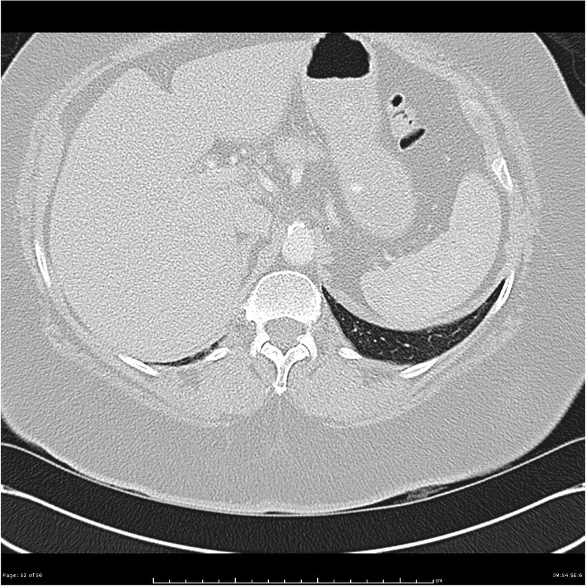 Benign metastasizing leiomyoma (Radiopaedia 26803-26962 Axial lung window 52).jpg