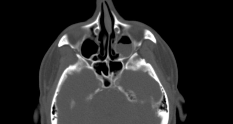 File:Benign mixed salivary tumor of the parotid gland (Radiopaedia 35261-36792 Axial bone window 5).jpg