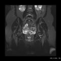 Bicornuate uterus- on MRI (Radiopaedia 49206-54297 Coronal STIR 11).jpg