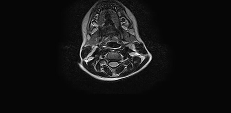 File:Bilateral Sprengel deformity with Klippel-Feil syndrome (Radiopaedia 66395-75650 Axial T2 11).jpg