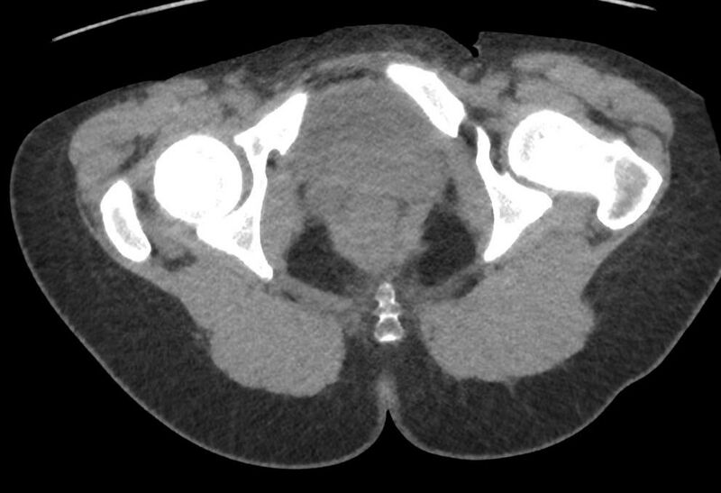 File:Bilateral mature cystic ovarian teratoma (Radiopaedia 88821-105592 Axial non-contrast 56).jpg
