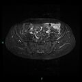 Bilateral ovarian fibroma (Radiopaedia 44568-48293 Axial STIR 7).jpg