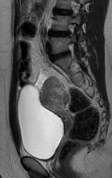 File:Bilateral ovarian fibrothecomas - adolescent (Radiopaedia 86604-102707 Sagittal T2 20).jpg