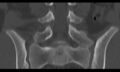 Bilateral pars defect (Radiopaedia 26691-26846 Coronal bone window 26).jpg