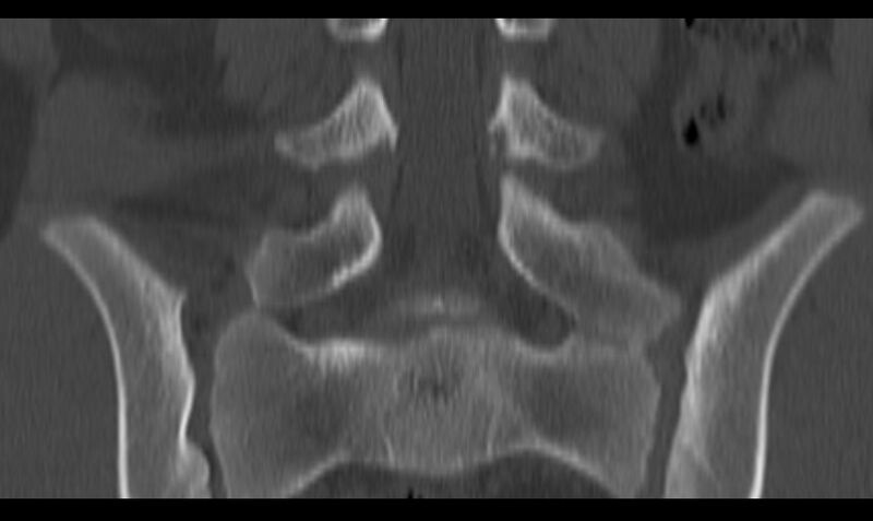 File:Bilateral pars defect (Radiopaedia 26691-26846 Coronal bone window 26).jpg