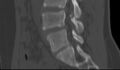 Bilateral pars defect (Radiopaedia 26691-26846 Sagittal bone window 37).jpg
