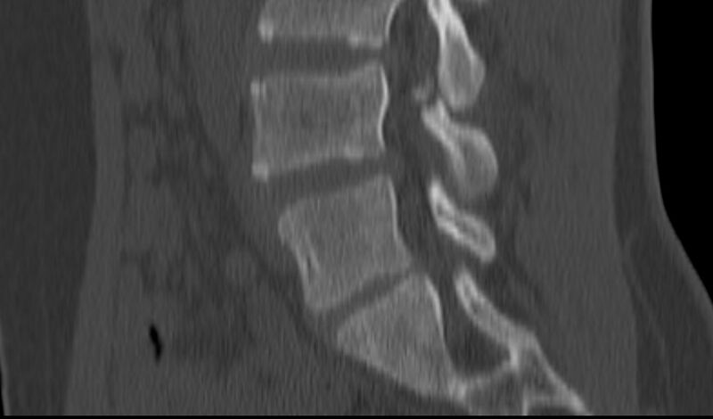 File:Bilateral pars defect (Radiopaedia 26691-26846 Sagittal bone window 37).jpg