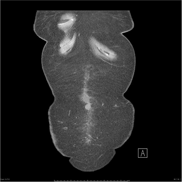 File:Bilateral psoas hematomas (Radiopaedia 24057-24279 B 6).jpg