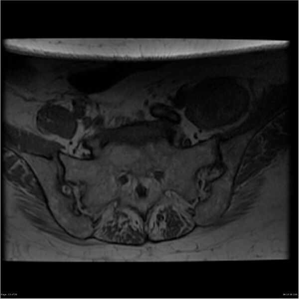 File:Bilateral psoas hematomas (Radiopaedia 24057-24280 T1 13).jpg