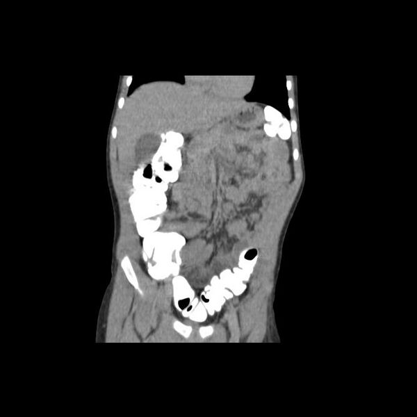 File:Bilateral renal malrotation (Radiopaedia 30901-31606 Coronal C+ delayed 7).jpg