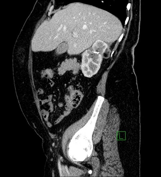 File:Bilateral sporadic synchronous clear cell renal cell carcinoma (Radiopaedia 85035-100575 G 82).jpg