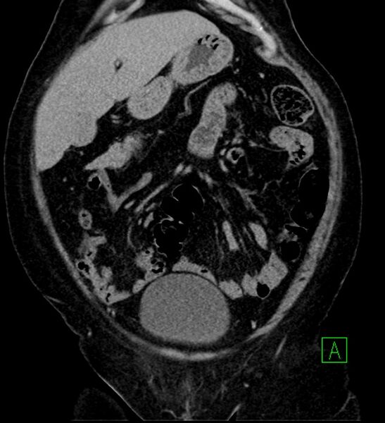 File:Bilateral sporadic synchronous clear cell renal cell carcinoma (Radiopaedia 85035-100575 I 6).jpg